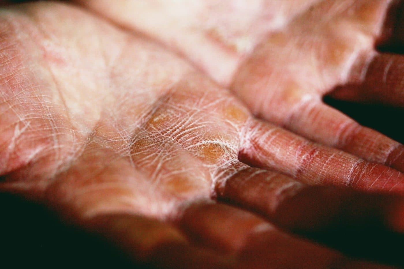 Close view of dry, cracked skin on an open palm